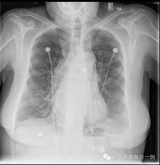 【病例】横结肠疝入心包继发心包填塞1例X线及CT 【病例】横结肠疝入心包继发心包填塞1例X线及CT