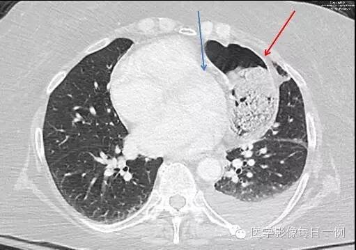 【病例】横结肠疝入心包继发心包填塞1例X线及CT 【病例】横结肠疝入心包继发心包填塞1例X线及CT