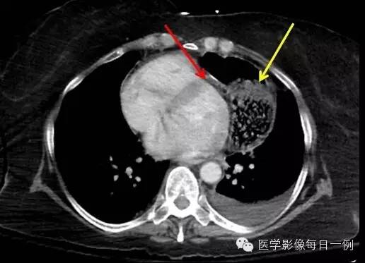 【病例】横结肠疝入心包继发心包填塞1例X线及CT