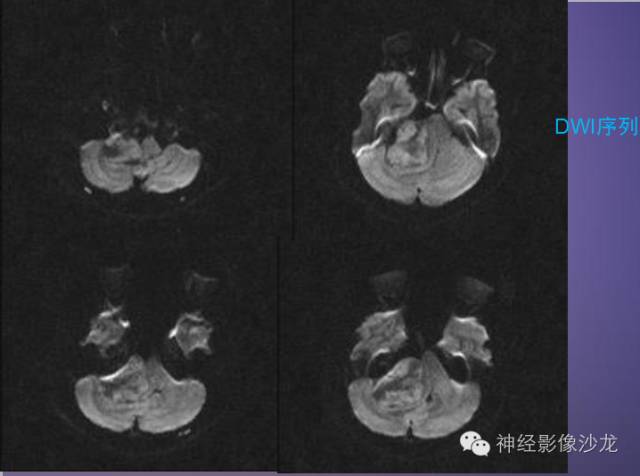 【病例】听神经瘤1例CT及MR影像表现与鉴别