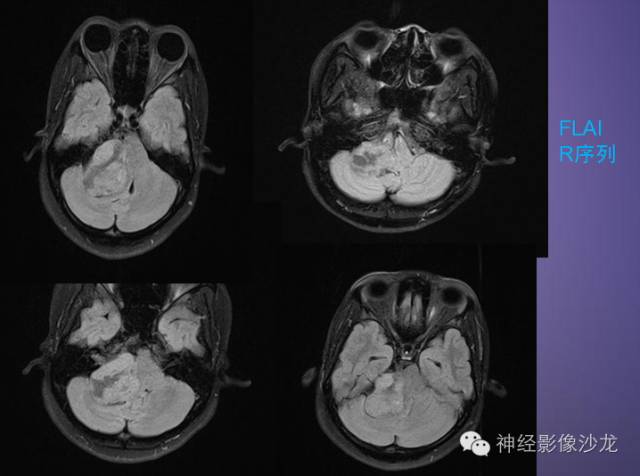 【病例】听神经瘤1例CT及MR影像表现与鉴别