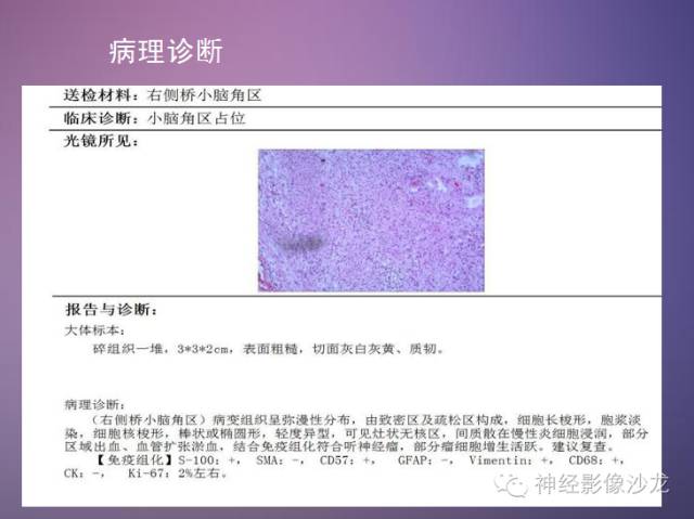 【病例】听神经瘤1例CT及MR影像表现与鉴别