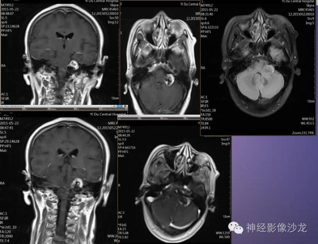 【病例】听神经瘤1例CT及MR影像表现与鉴别