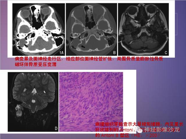 【病例】听神经瘤1例CT及MR影像表现与鉴别