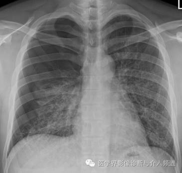 【病例】弥漫性肺骨化症1例CT影像表现
