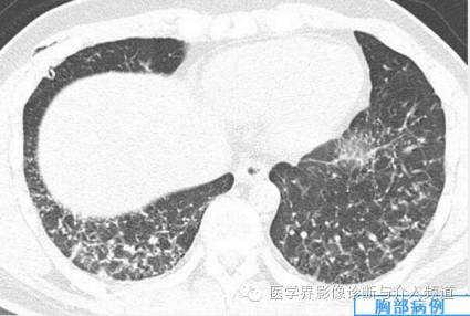 【病例】弥漫性肺骨化症1例CT影像表现