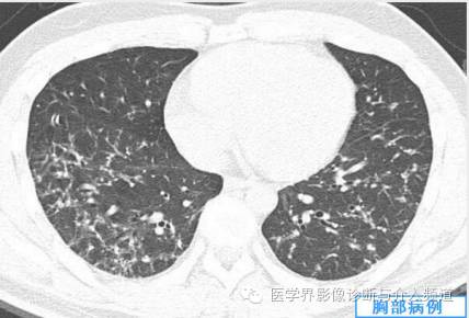 【病例】弥漫性肺骨化症1例CT影像表现