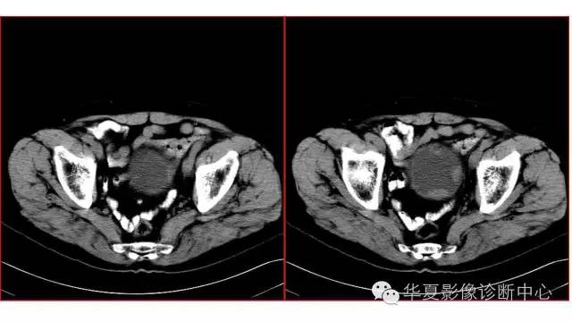 【病例】腺性膀胱炎1例CT影像表现