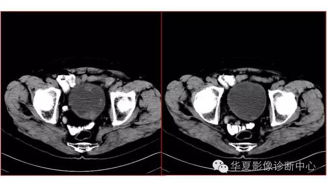 【病例】腺性膀胱炎1例CT影像表现