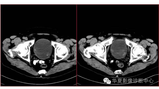 【病例】腺性膀胱炎1例CT影像表现