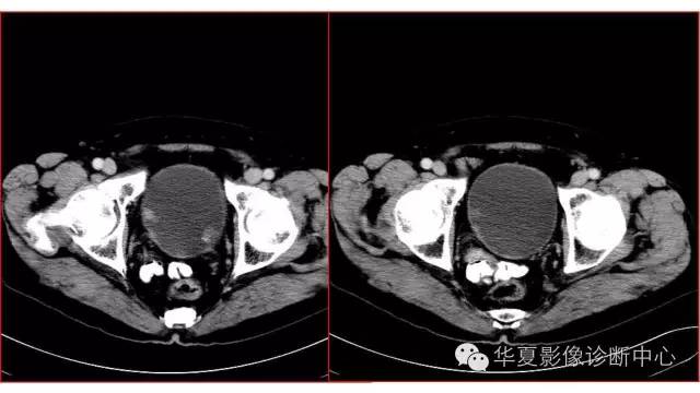 【病例】腺性膀胱炎1例CT影像表现