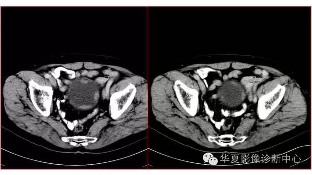【病例】腺性膀胱炎1例CT影像表现