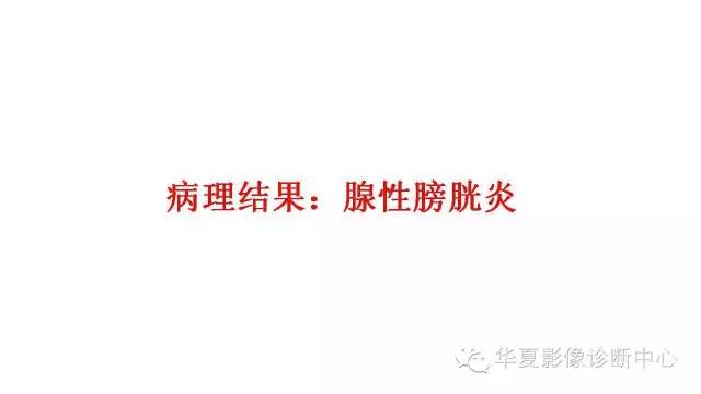 【病例】腺性膀胱炎1例CT影像表现