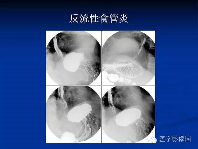 【PPT】食道疾病影像学