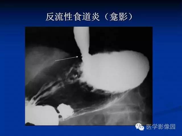 【PPT】食道疾病影像学