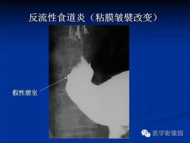 【PPT】食道疾病影像学