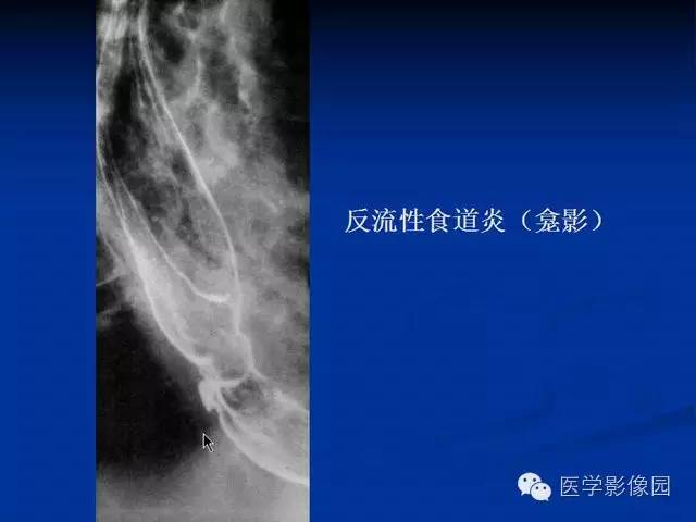【PPT】食道疾病影像学