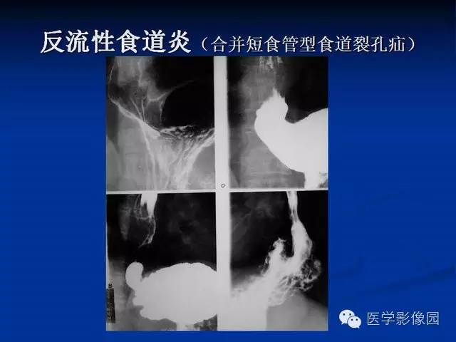 【PPT】食道疾病影像学