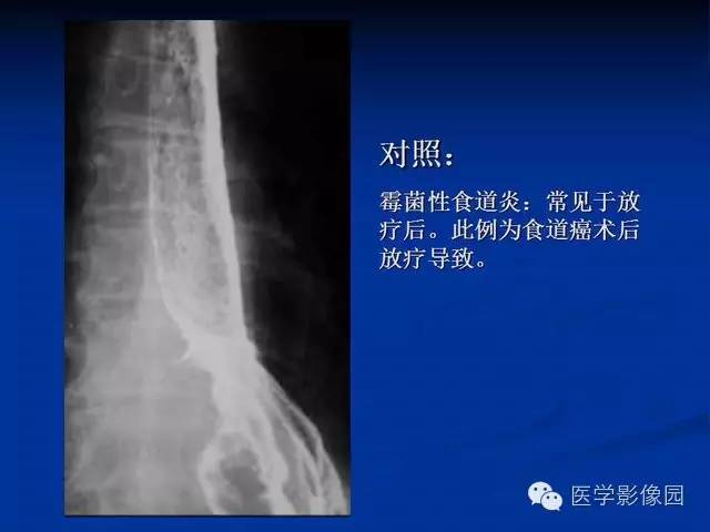 【PPT】食道疾病影像学