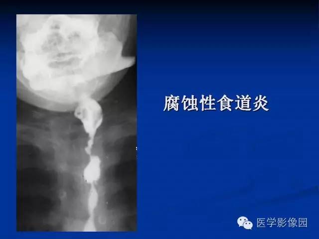 【PPT】食道疾病影像学