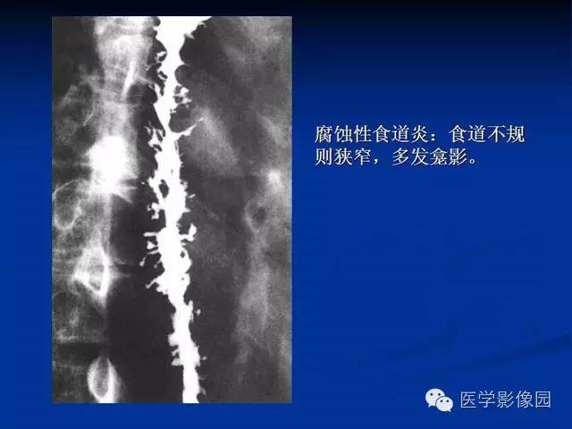 【PPT】食道疾病影像学