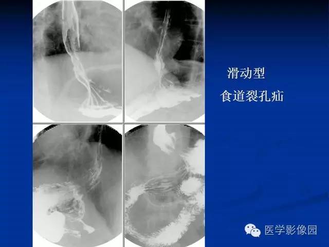 【PPT】食道疾病影像学