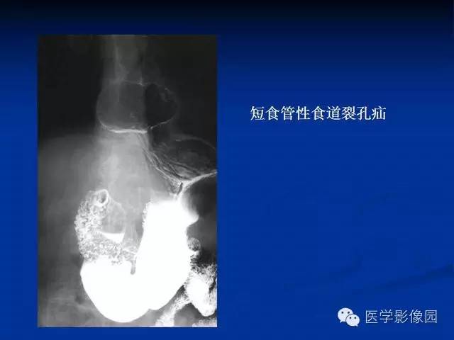 【PPT】食道疾病影像学