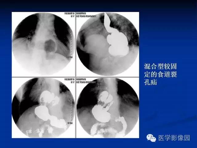 【PPT】食道疾病影像学