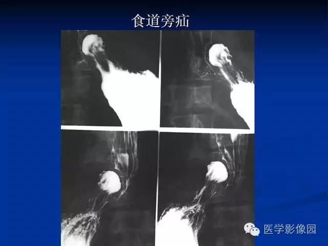 【PPT】食道疾病影像学