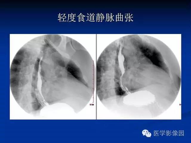【PPT】食道疾病影像学