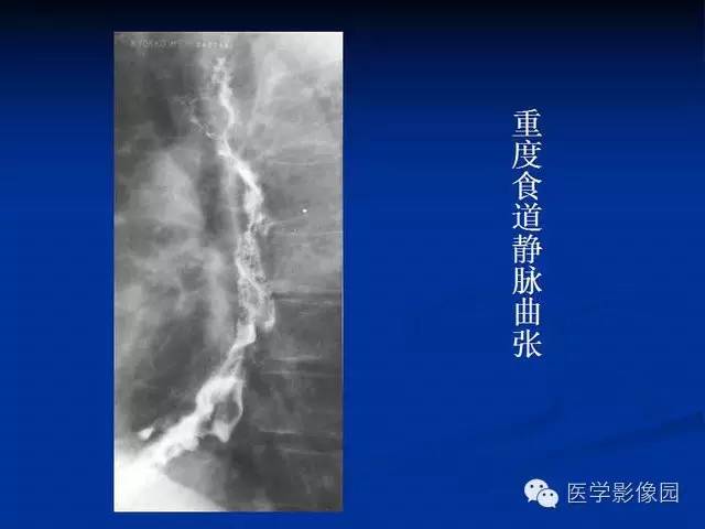 【PPT】食道疾病影像学