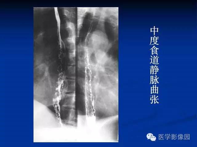 【PPT】食道疾病影像学