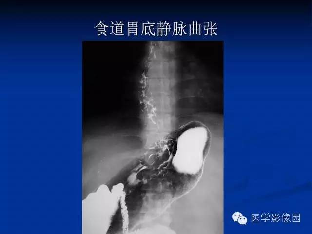 【PPT】食道疾病影像学