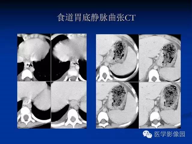 【PPT】食道疾病影像学