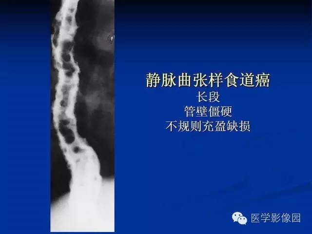 【PPT】食道疾病影像学