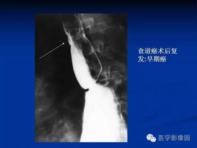【PPT】食道疾病影像学