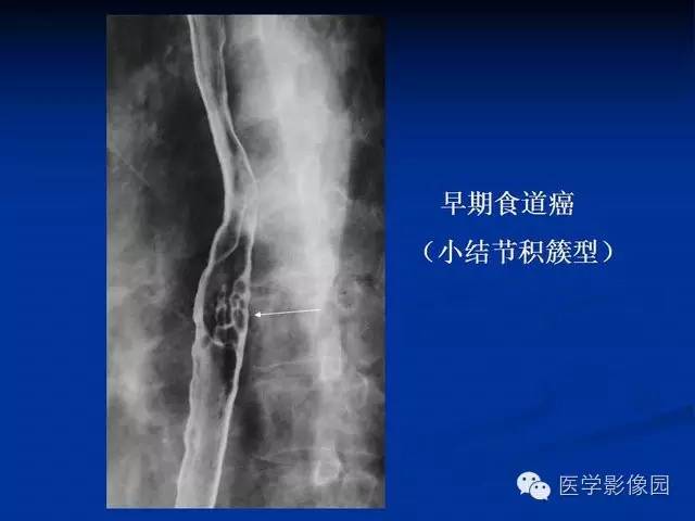 【PPT】食道疾病影像学