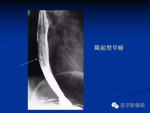 【PPT】食道疾病影像学