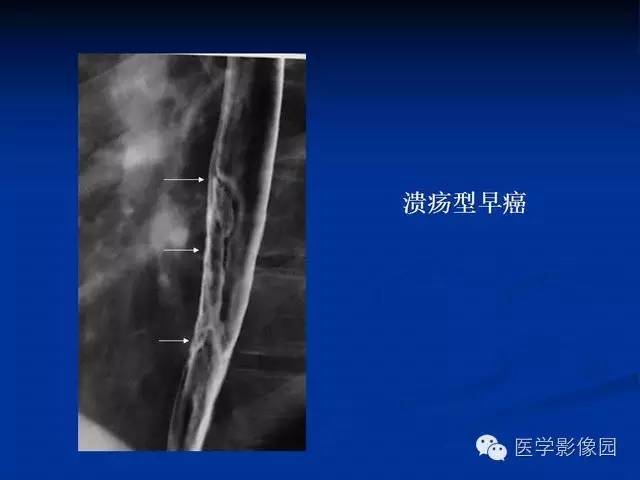 【PPT】食道疾病影像学