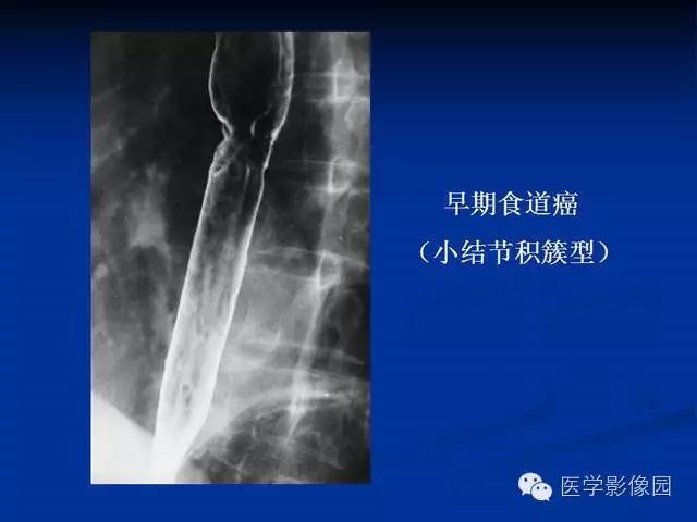 【PPT】食道疾病影像学