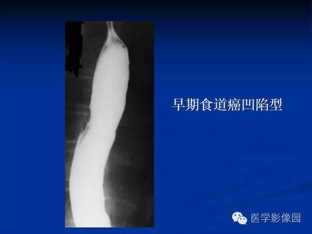 【PPT】食道疾病影像学