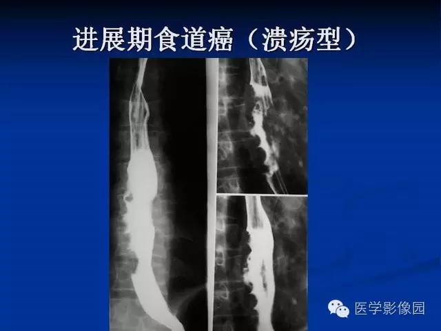【PPT】食道疾病影像学