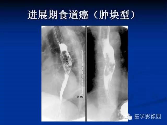 【PPT】食道疾病影像学
