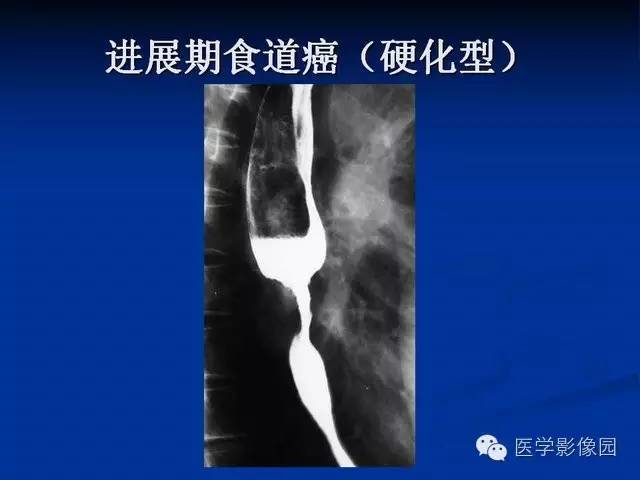 【PPT】食道疾病影像学