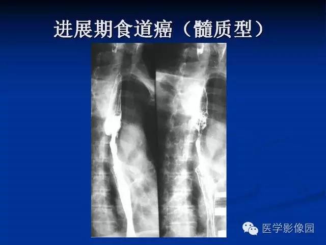 【PPT】食道疾病影像学