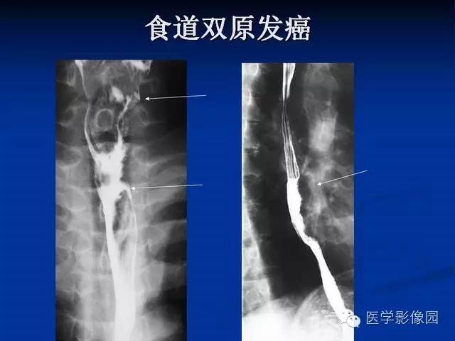 【PPT】食道疾病影像学
