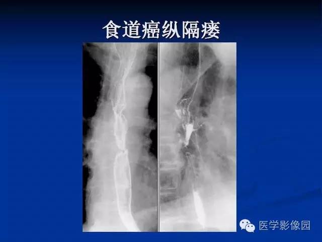【PPT】食道疾病影像学