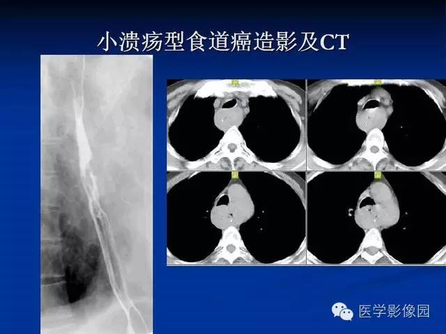 【PPT】食道疾病影像学