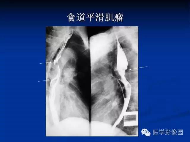 【PPT】食道疾病影像学