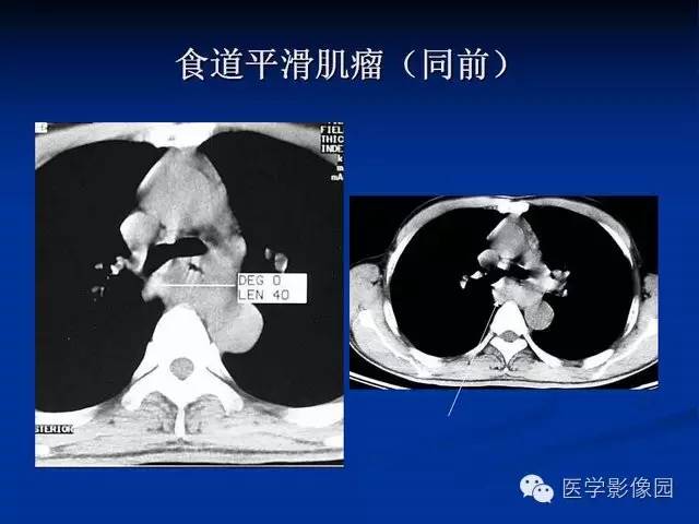 【PPT】食道疾病影像学